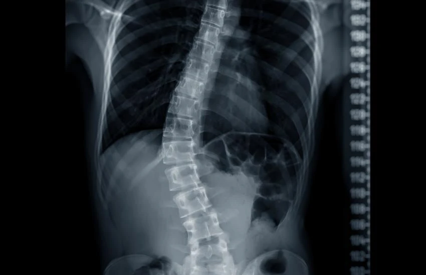 Escoliose na adolescência: quando não dói, ...