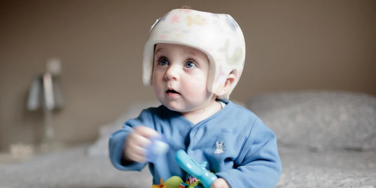 Capacete para assimetria craniana: quando realmente é necessário?