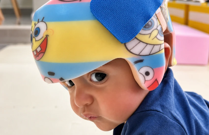 Órtese Craniana - Capacete para assimetria craniana